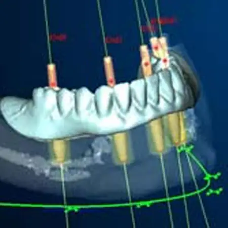 computer Guided Dental Implants