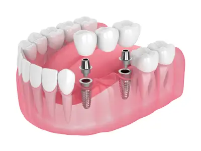 Dental Bridge procedure