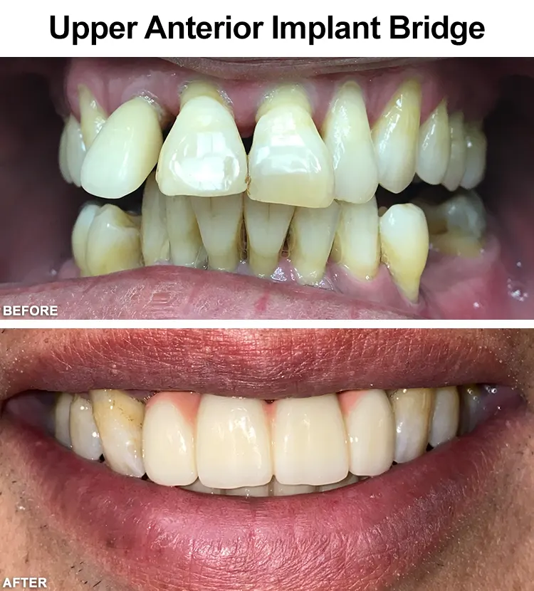 Upper Anterior Implant Bridge