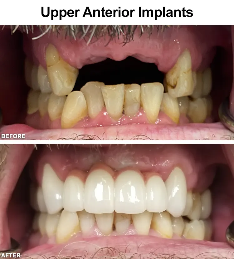 Dental Implants done right